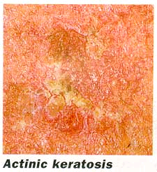Queretosis Actínica (AK's)